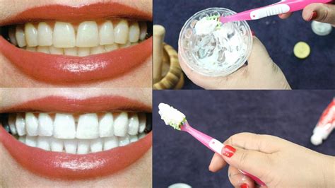 طريقة تبييض الاسنان في يوم واحد